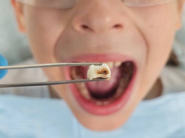 Best Emergency Dental Extractions in Waldorf, MD